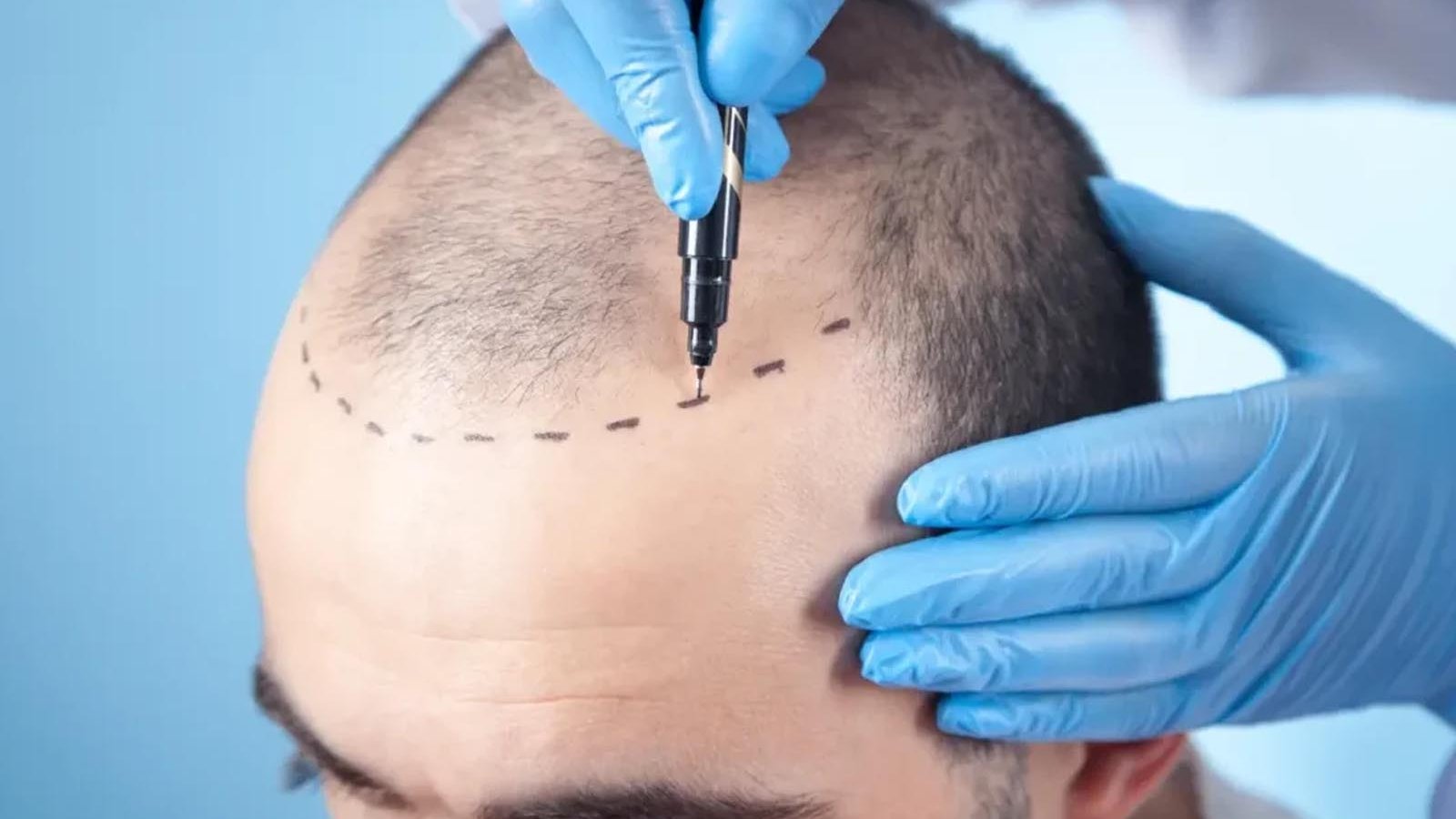 FUE Haartransplantation Schweiz – Sapphire FUE mit minimalen Narben